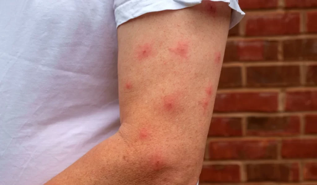 mosquito bites